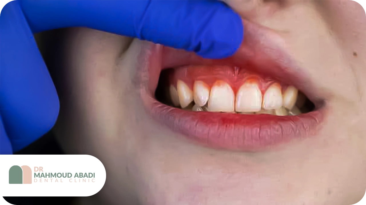 قرمز شدن لثه کودک