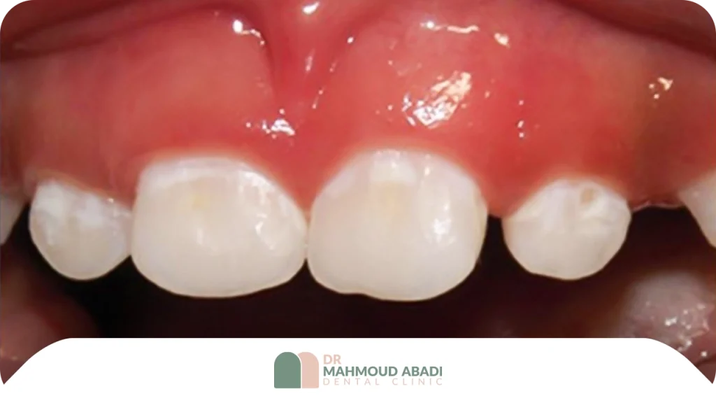 پوسیدگی اولیه دندان شیری