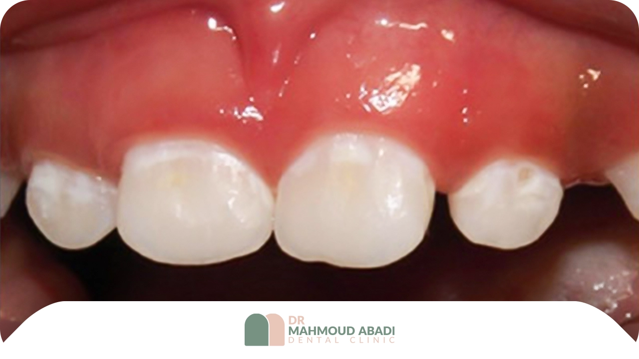پوسیدگی اولیه دندان شیری